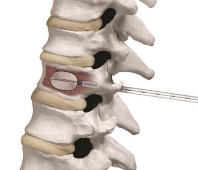 vertebral augmentation